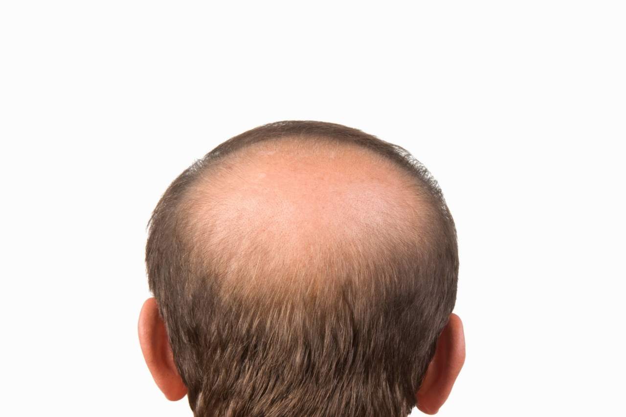 ¿Cómo prevenir alopecia androgenética?, según Natura Estilo
