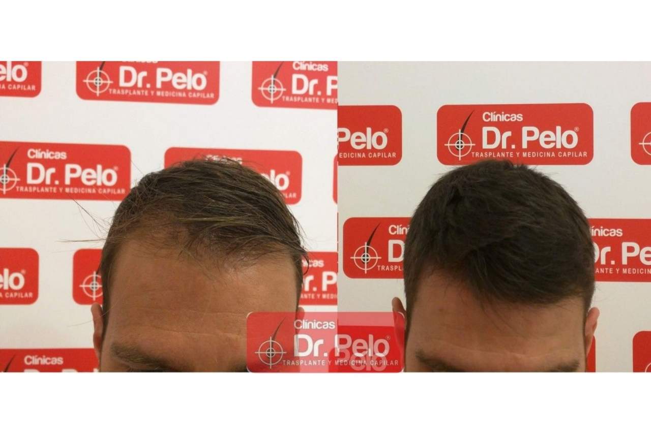 Señales de alopecia por Clínicas Dr. Pelo