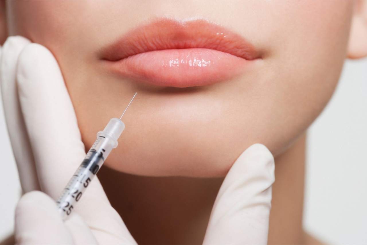 Diseño de labios con ácido hialurónico en Barcelona por Dr. Zito