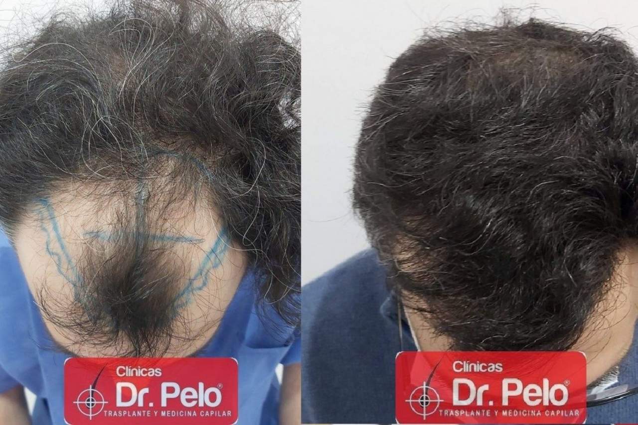 ¿Cómo es el injerto capilar en Sevilla en la Clínica Dr. Pelo?