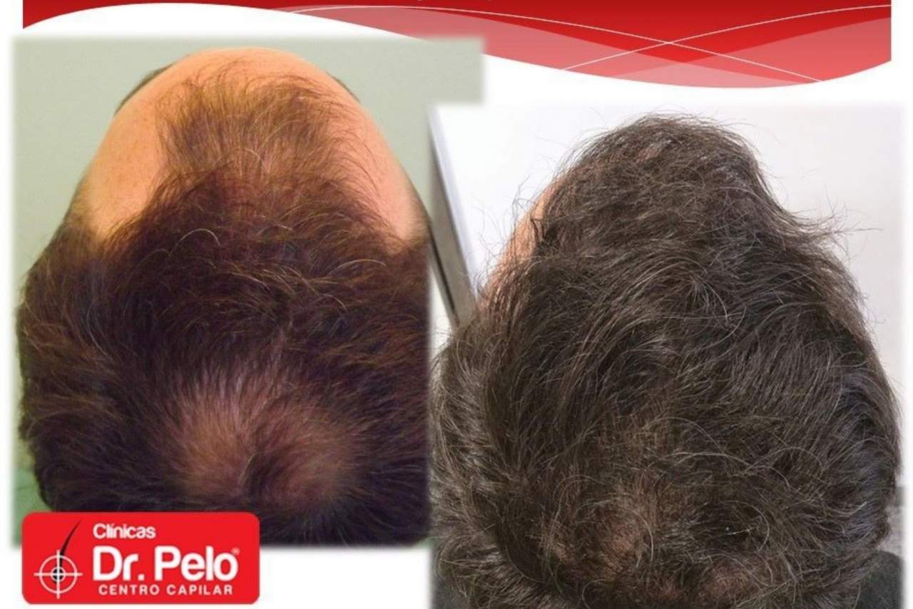 ¿Es el trasplante capilar la nueva tendencia de la medicina estética?: Dr. Pelo