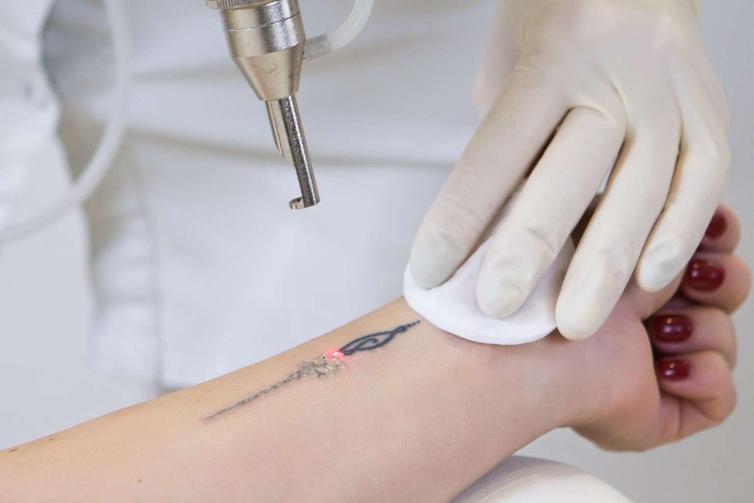 Yag Láser para eliminar tatuajes  por Bodyslim