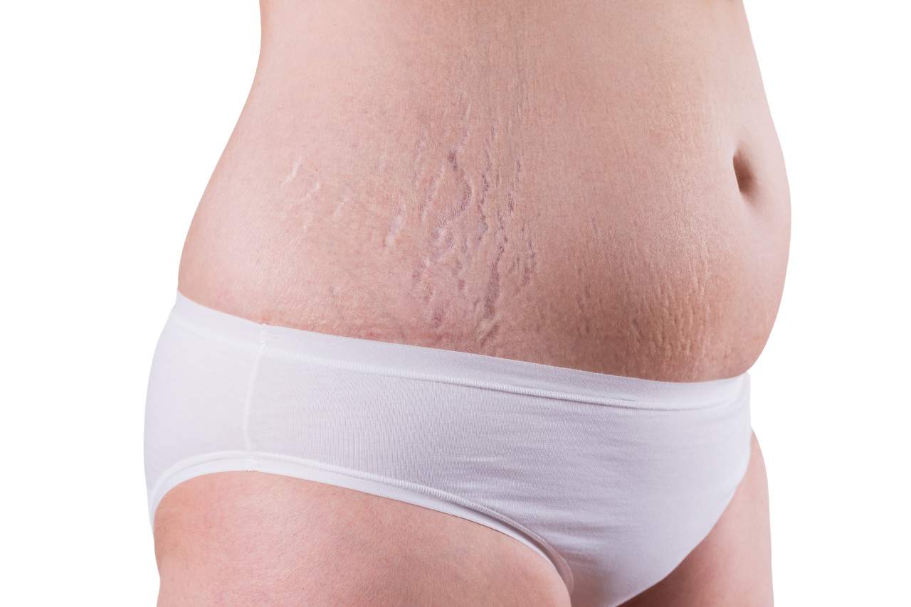 ¿Cómo quitar las estrías? por Clínica Estética Alicante