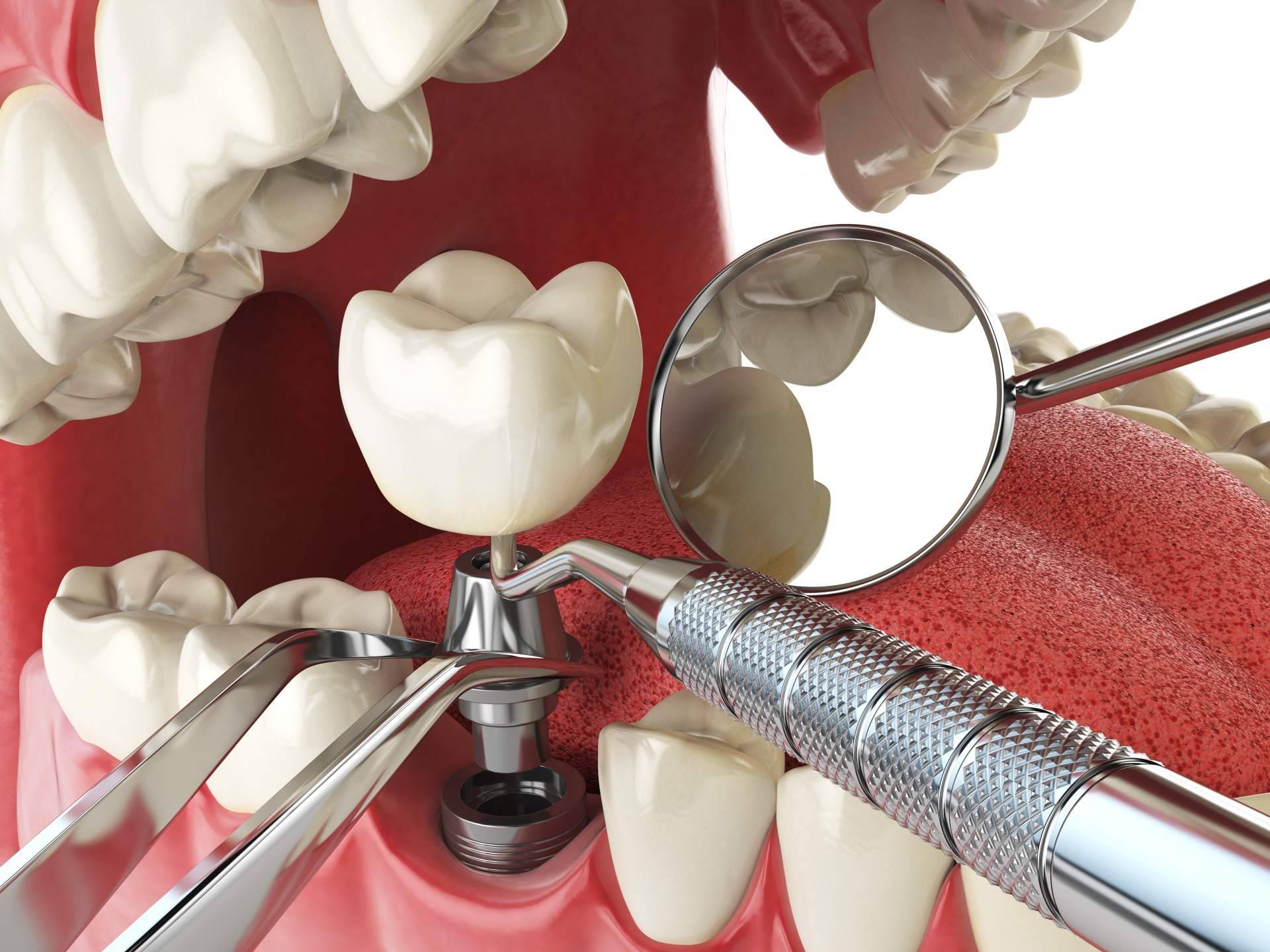 La Clínica Artydents en Madrid logra conseguir dientes fijos en un solo día gracias a los implantes dentales de titanio V