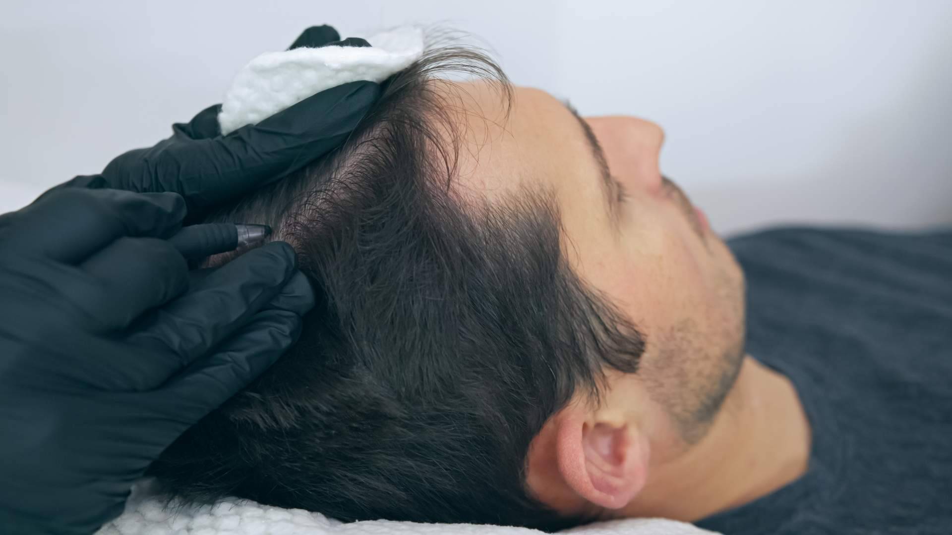 Distrito Wellness Concept dispone de tratamientos de micropigmentación capilar para cubrir las zonas afectadas por la pérdida de cabello