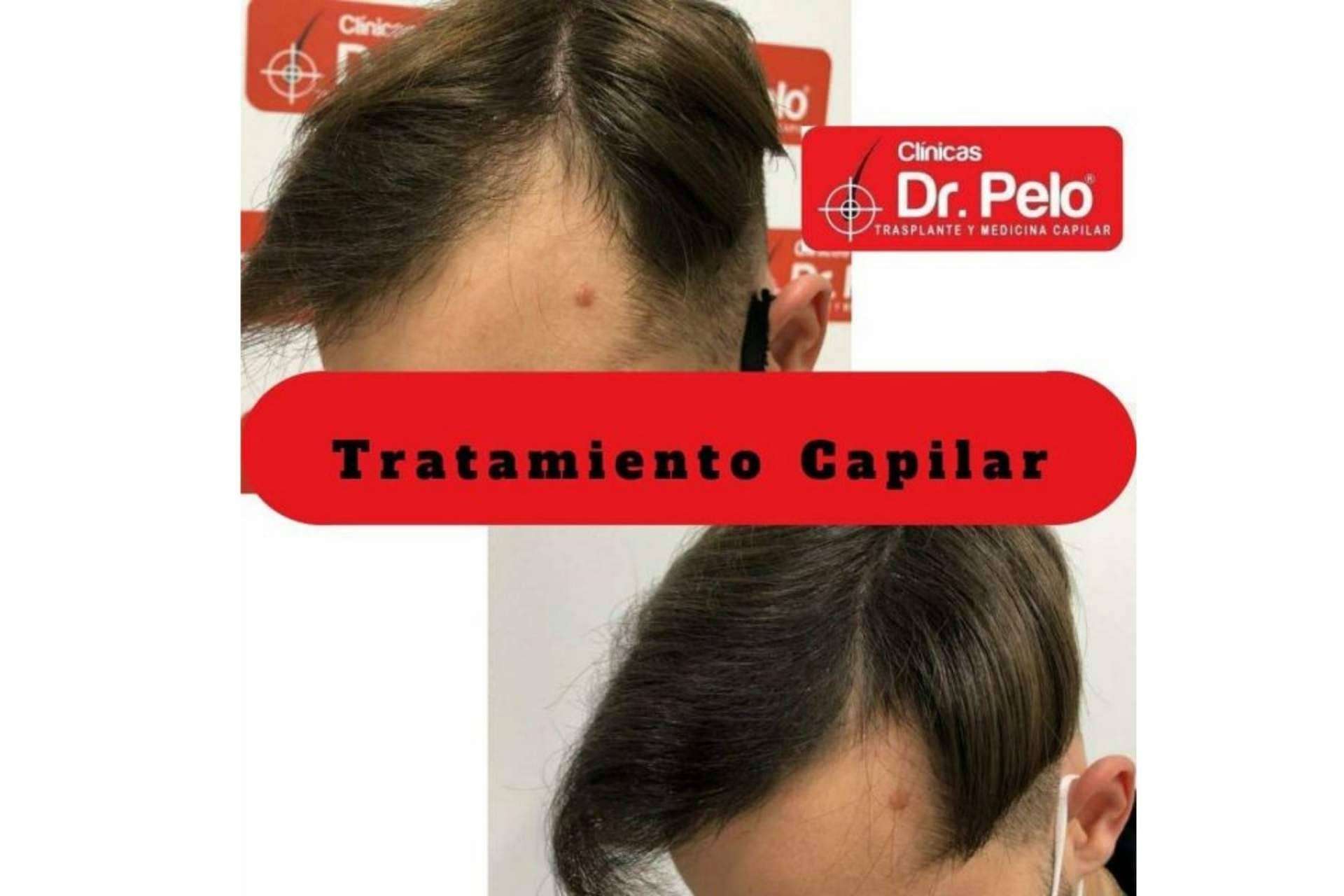 Clínica Dr. Pelo: centro recomendado para lograr los mejores resultados de trasplante capilar en España