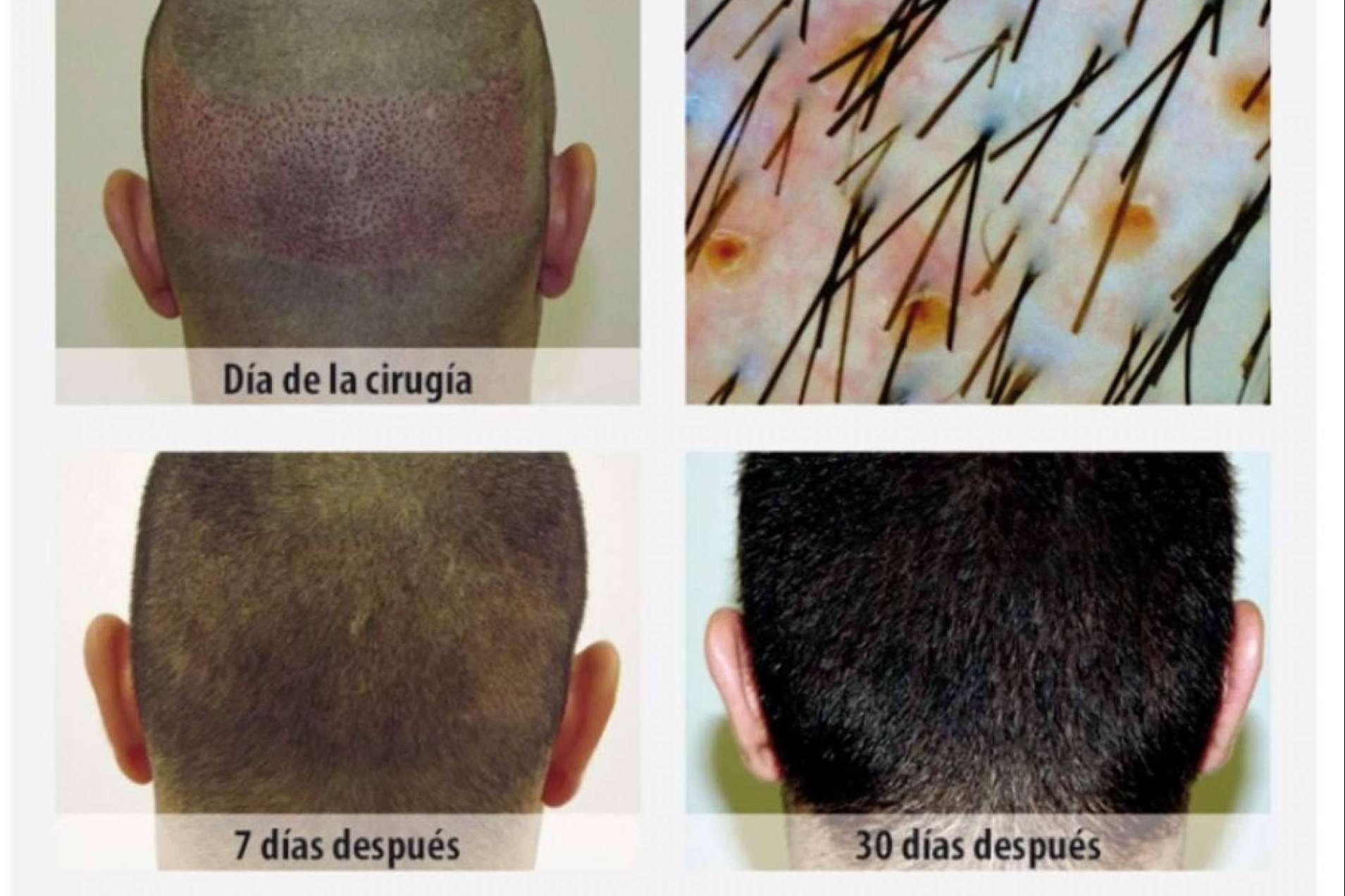 Clínica Dr.Pelo: ¿Cuál es la mejor clínica para someterse a un injerto capilar en Sevilla?