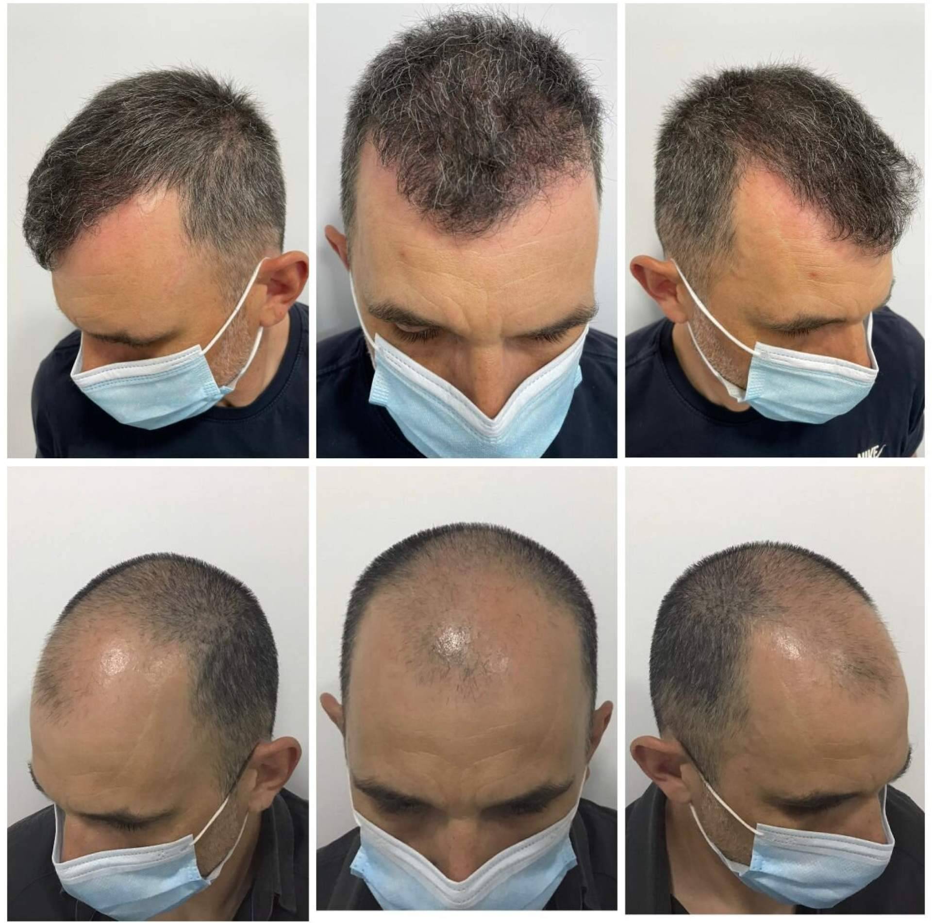 El injerto capilar en Barcelona más natural y denso ofrecido por el Dr. Bruno Jacobovski