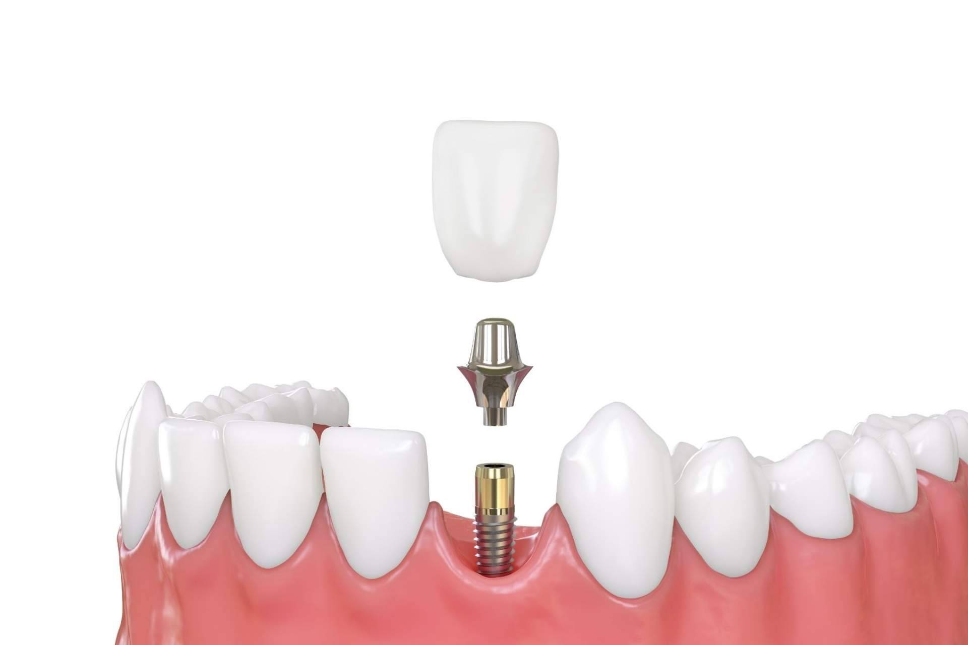 Los implantes de carga inmediata de Implant Clinics