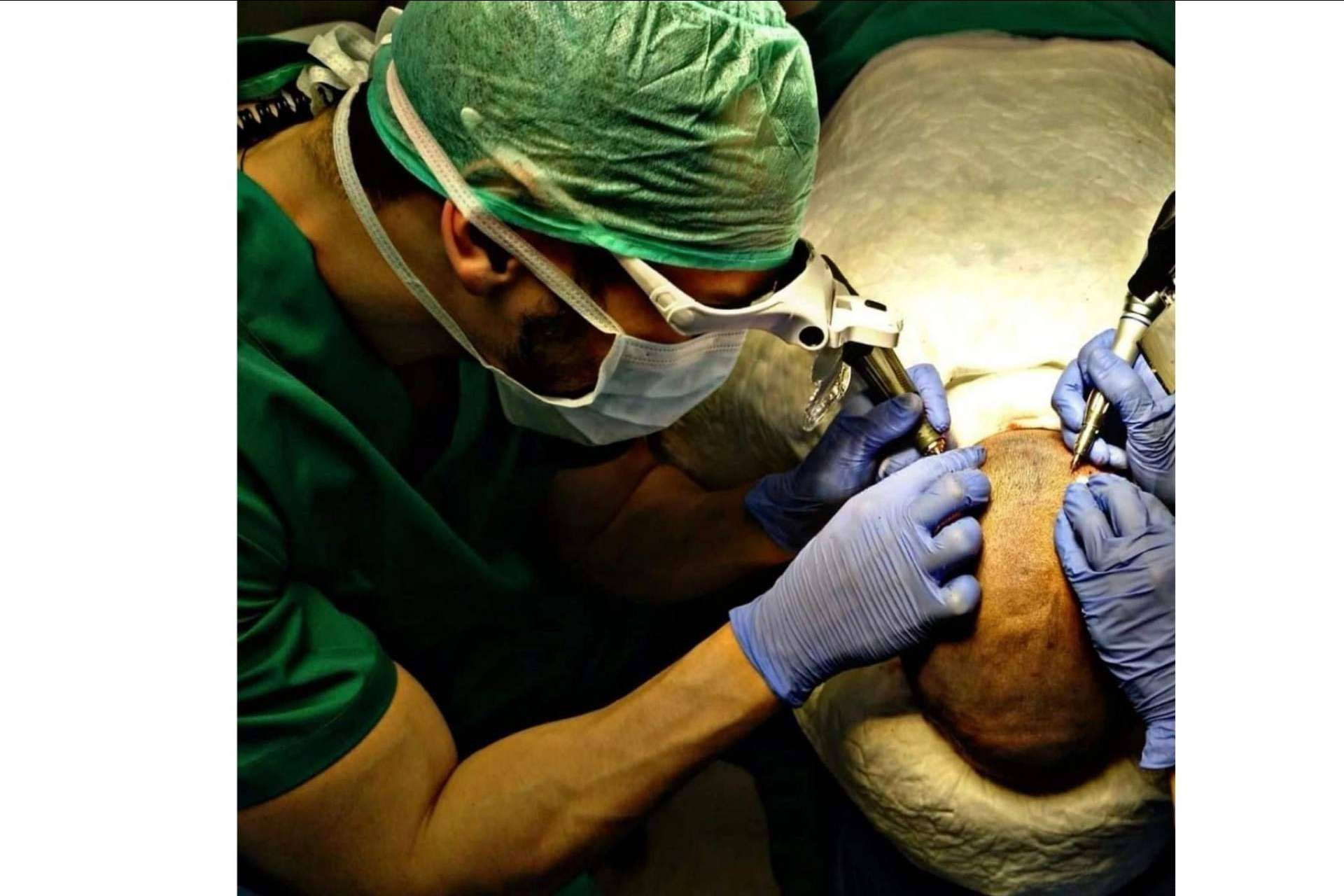 ¿A qué edad es recomendable realizarse un injerto capilar?, por Doctor Bern