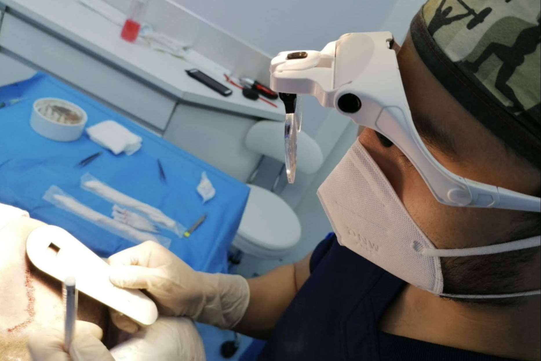 La fase del desierto capilar: ¿En qué momento se empieza a caer el pelo implantado?, según Doctor Bern