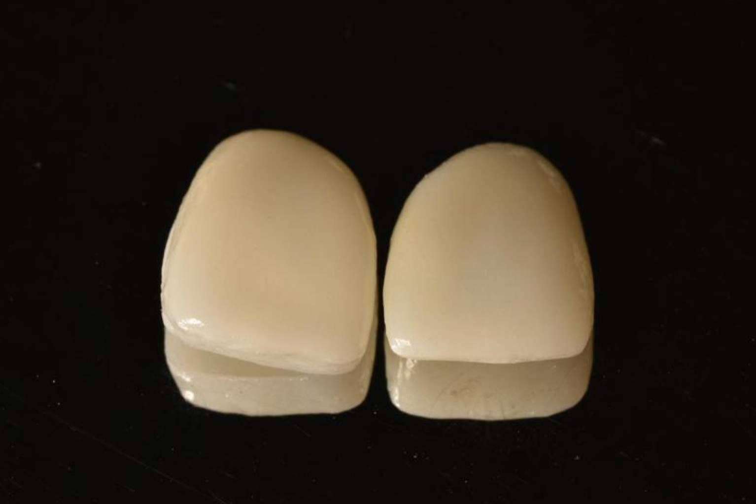 Sonrisa perfecta con tratamientos 0 invasivos: las carillas Emax y las inyectadas de composite de Implant Clinics