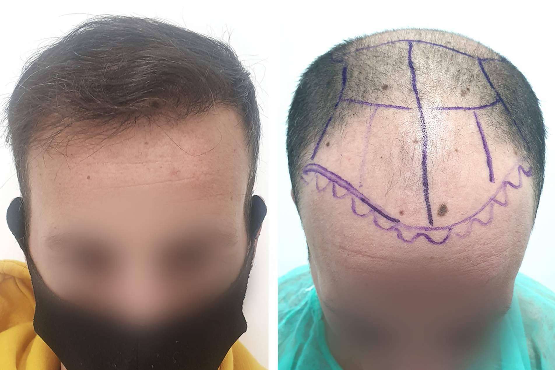 Técnica de injerto capilar sin cicatriz en la clínica Injermur