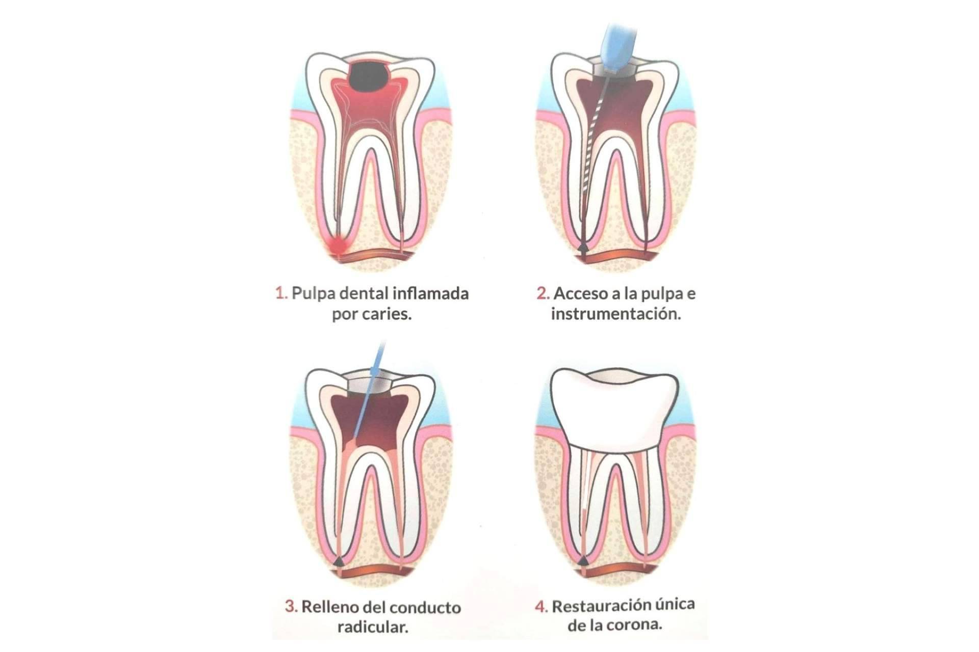 Implant Clinics realiza el procedimiento de endodoncia