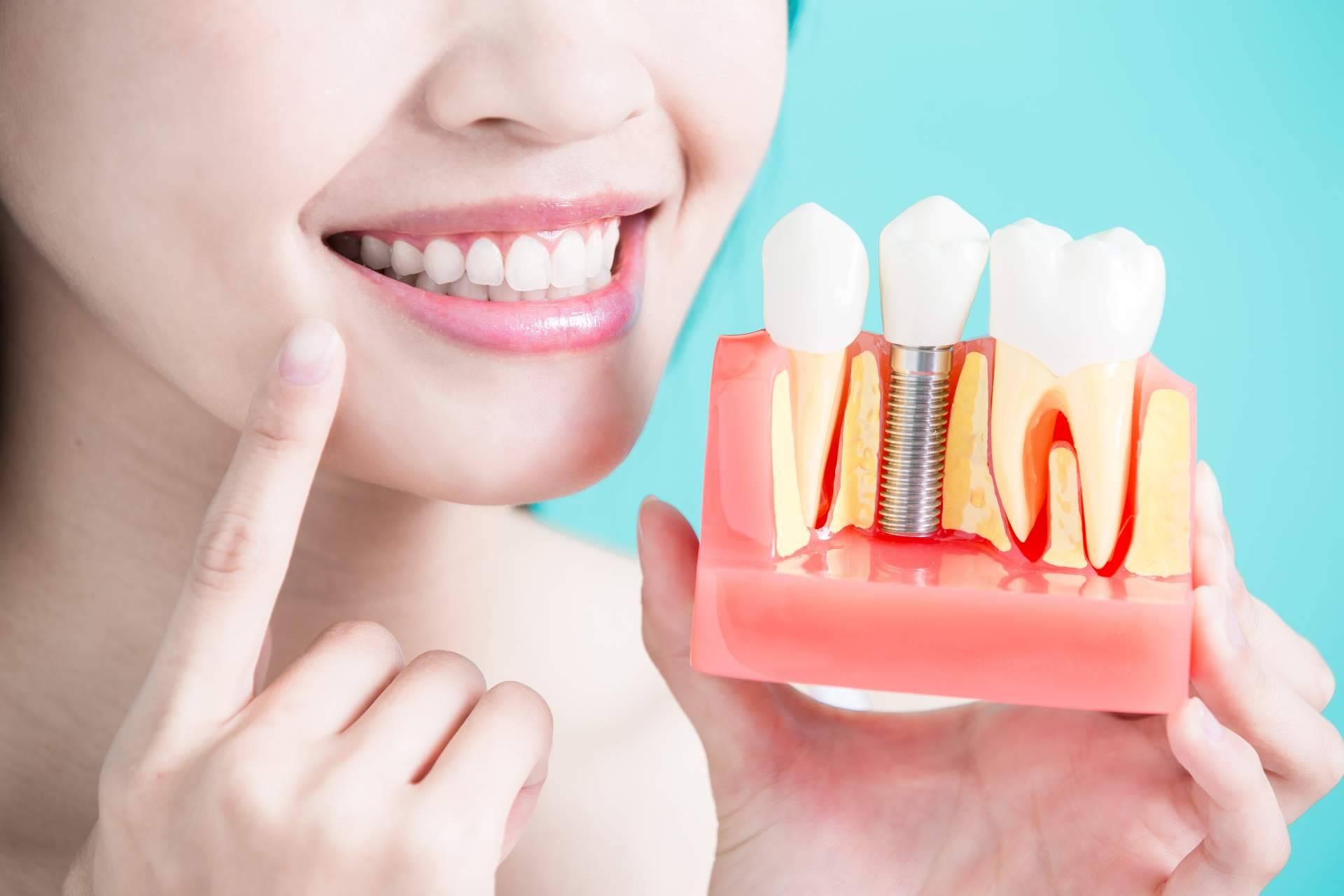 El procedimiento de implante dental de titanio en Sevilla que realiza Clínica Dental Helident