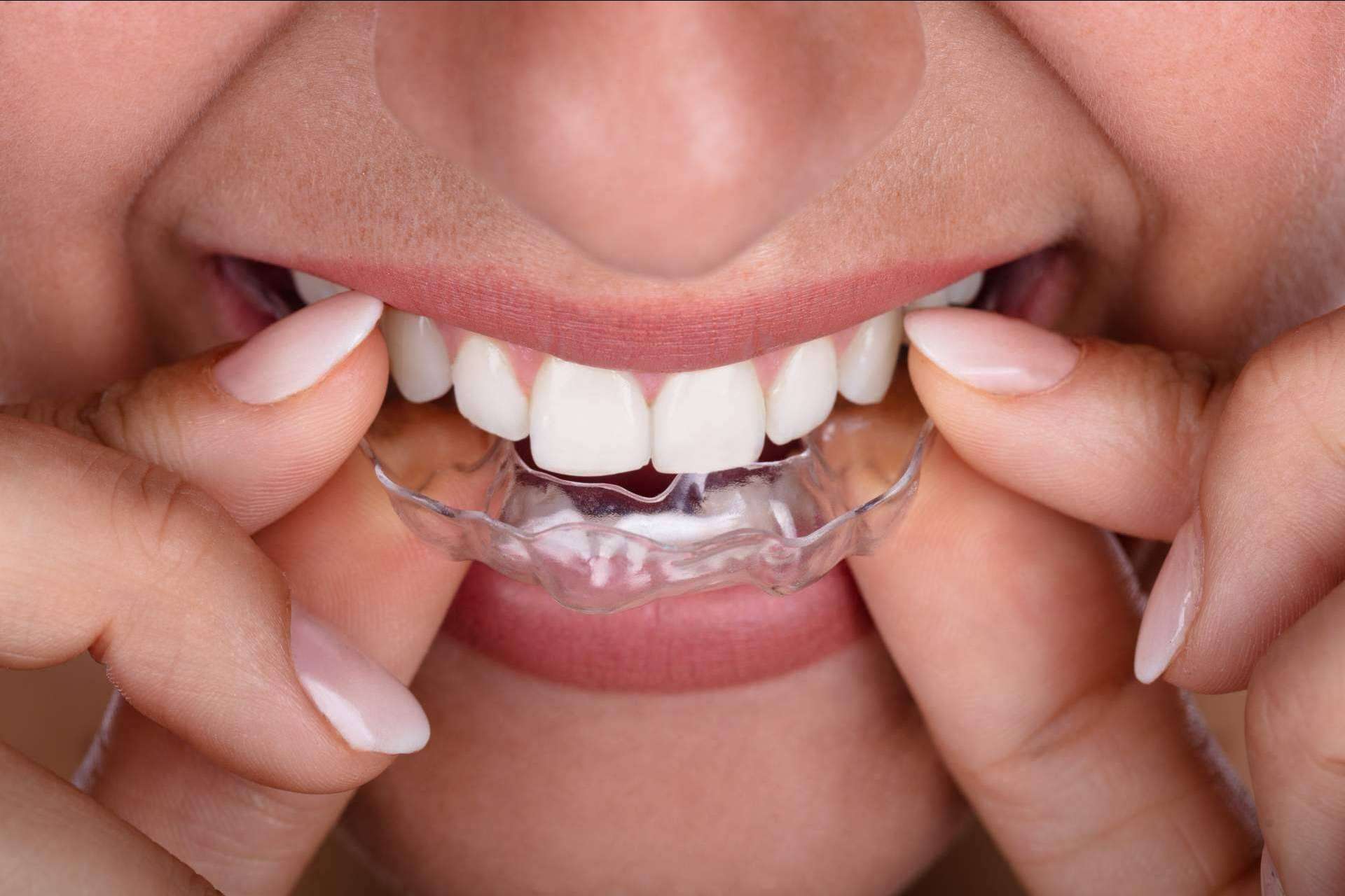 Los beneficios de elegir Smile Aligner como ortodoncia invisible