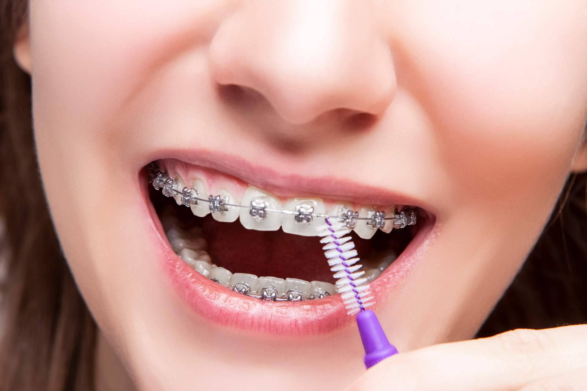 Servicios de ortodoncia Insignia en Badajoz en Clínica Sonrisas