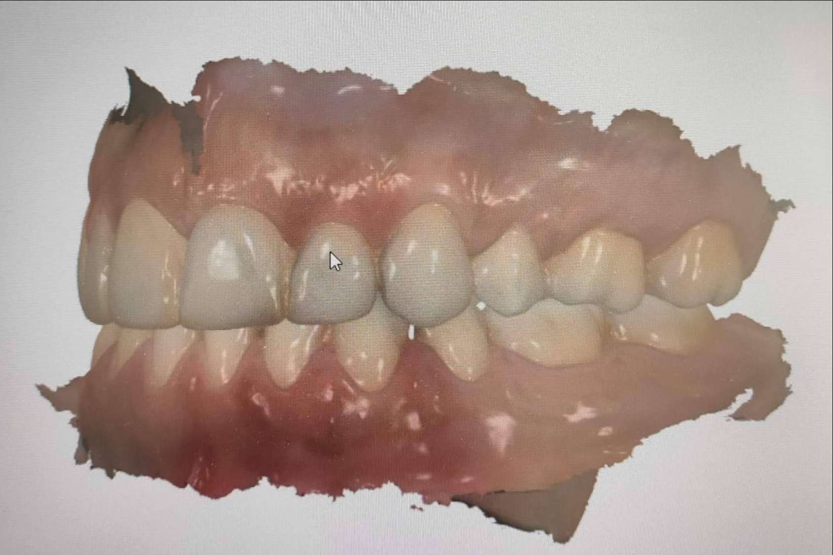 Toma de registros con 3Shape TRIOS, un escáner de última tecnología en la clínica dental Implant Clinics