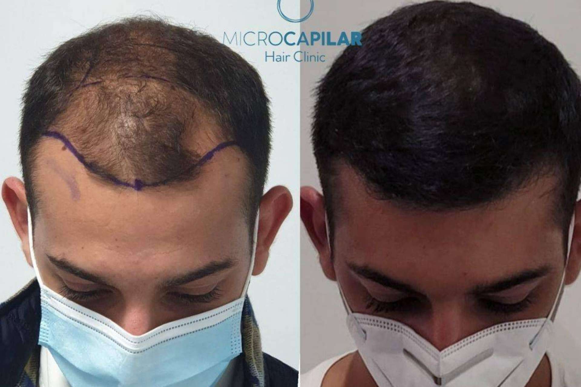 Un lugar para realizarse un injerto capilar con máxima extracción folicular es Microcapilar Hair Clinic
