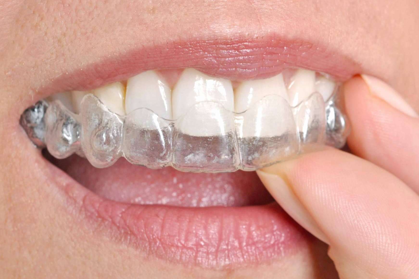 Los centros recomendados que cuentan con servicios de ortodoncia invisible disponen del Certificado de Calidad DentalQuality®