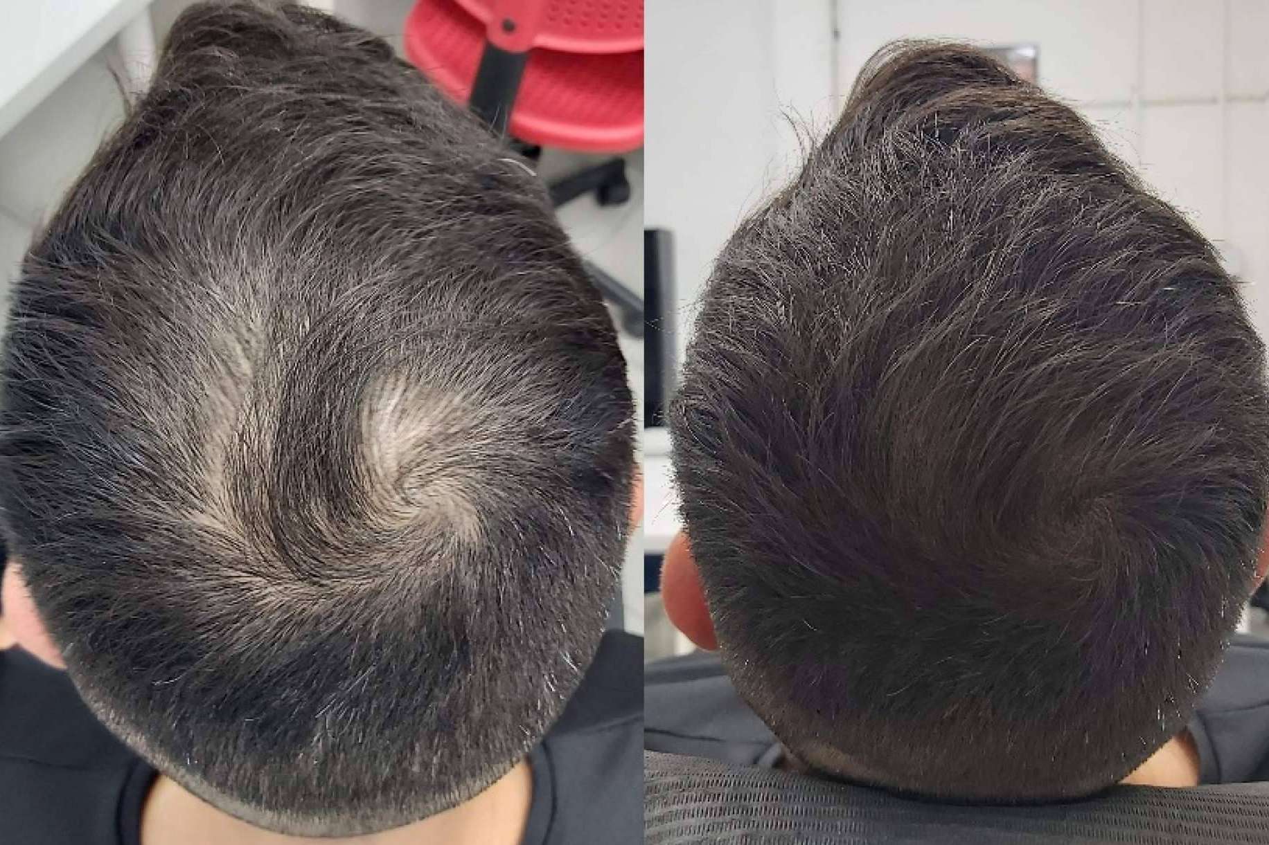 Las Clínicas Dr. Pelo ofrecen tratamientos de micropigmentación con efecto de redensificación