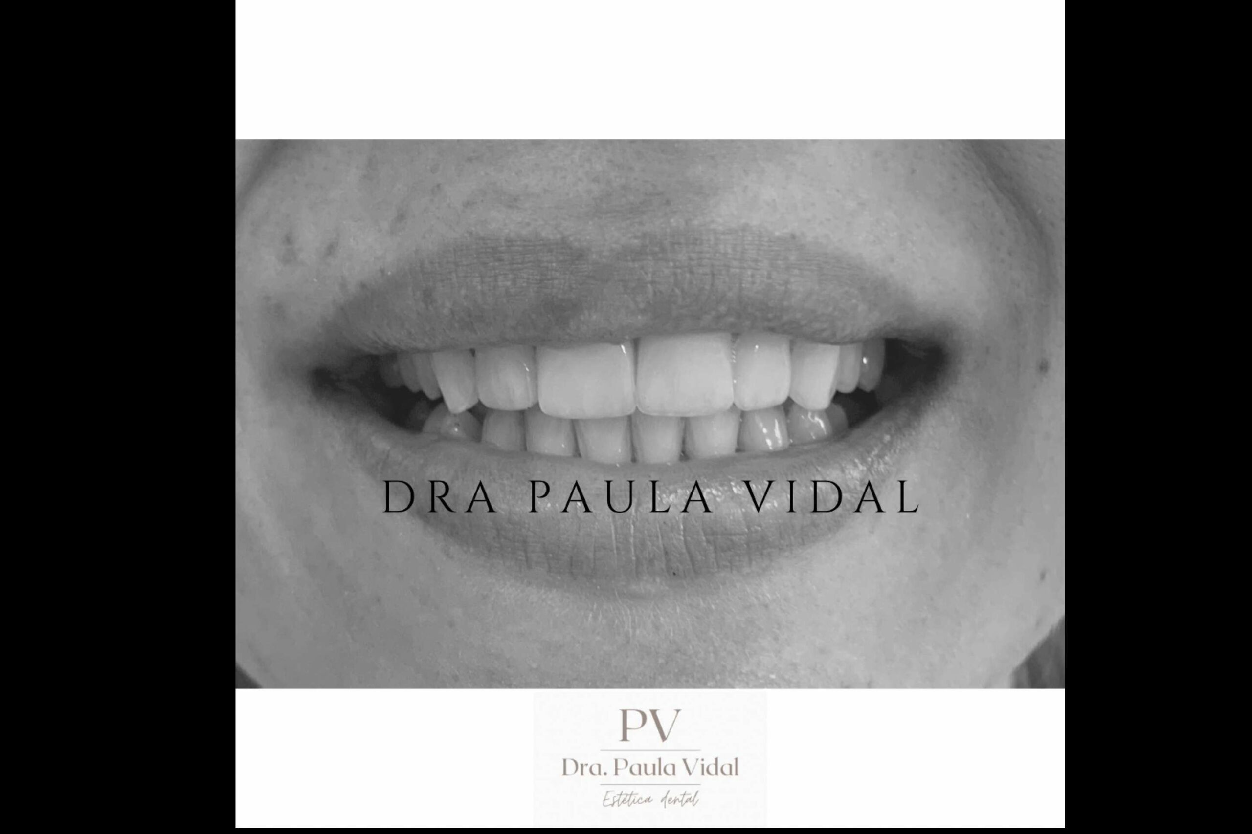 Clínica Paula Vidal, carillas dentales de calidad