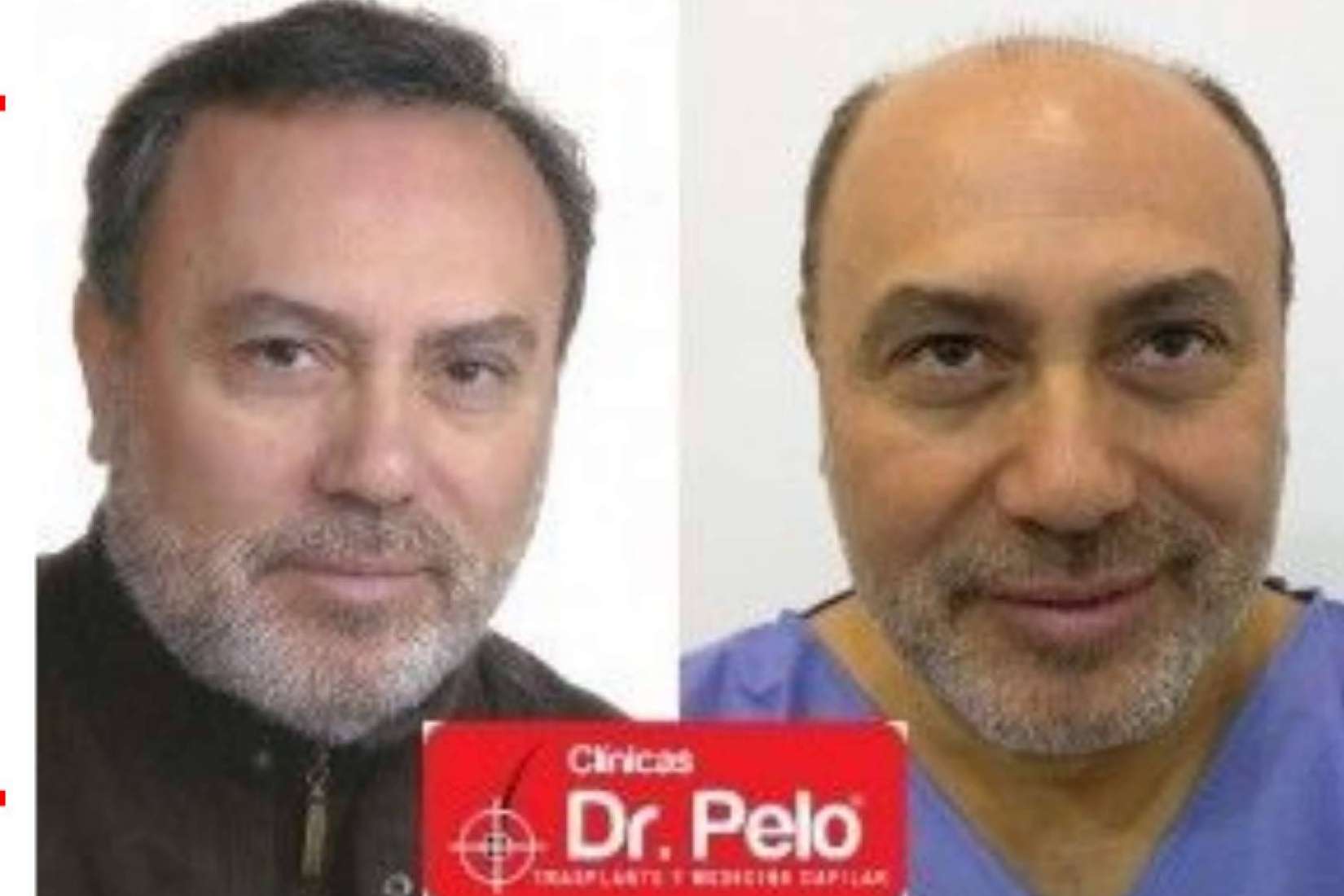 Conseguir trasplantes capilares con efecto natural de la mano de Clínicas Dr. Pelo