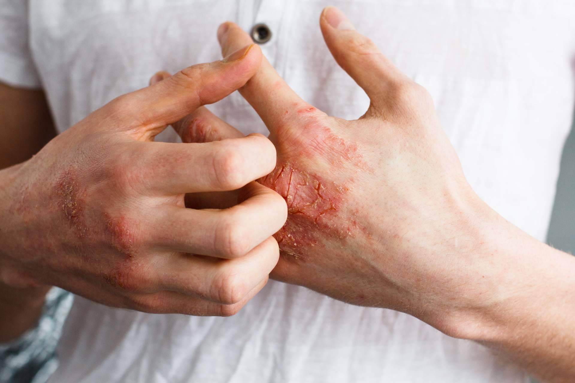Laboratorio Géomer expone las diferencias entre un eczema atópico y un eczema de contacto