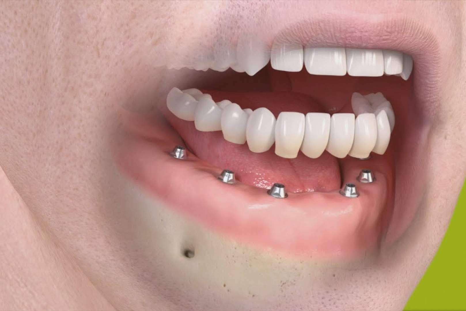 La clínica dental en Madrid Bordonclinic lleva a cabo rehabilitaciones orales complejas en un día