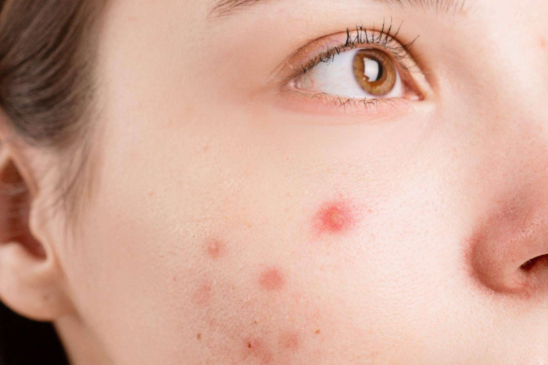 ¿Cuáles son los beneficios del tratamiento contra el acné de Bėyo Beauty?