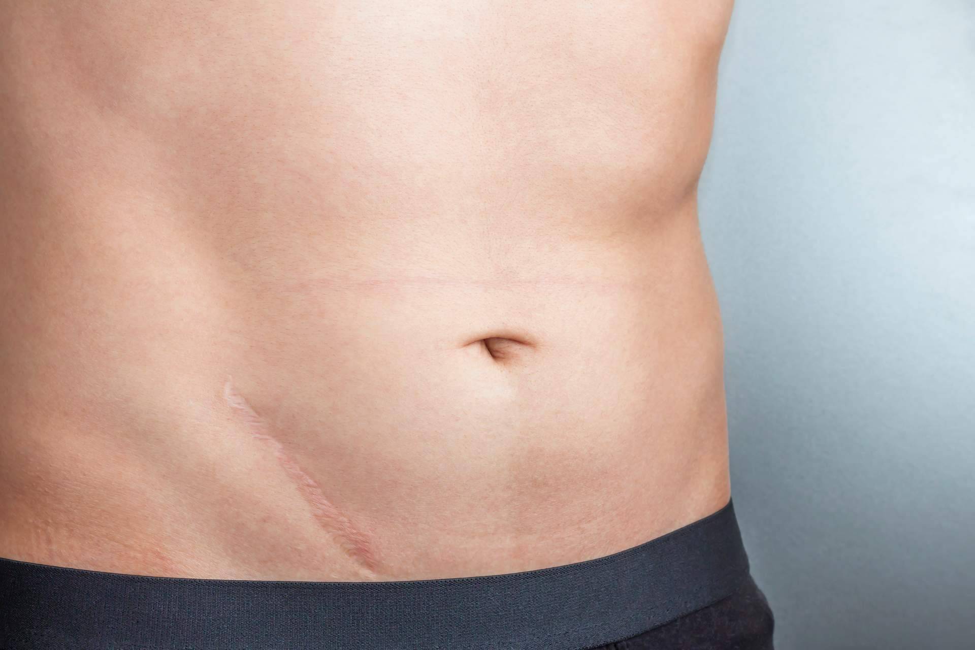 ¿Por qué es importante la fisioterapia y la osteopatía en el tratamiento de cicatrices y liberación de adherencias?