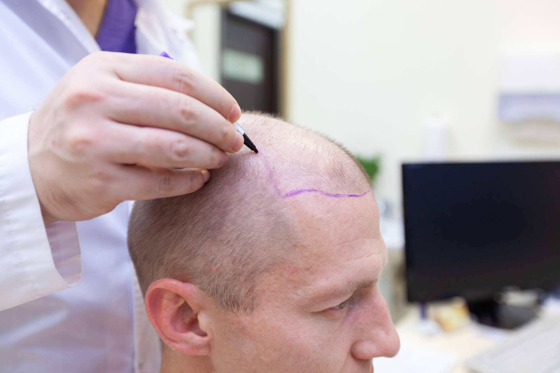 Élite Capilar ayuda a tratar la alopecia con injertos capilares efectivos