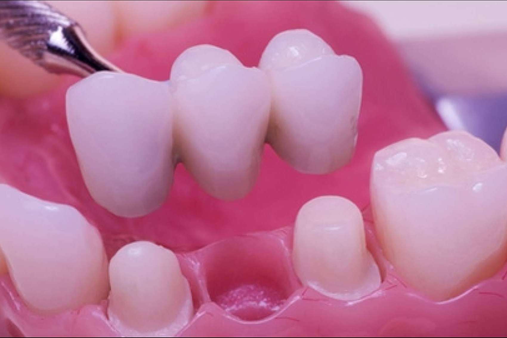 Dental Implantologie cuenta con un laboratorio propio para el servicio de estética dental y ortodoncia invisible