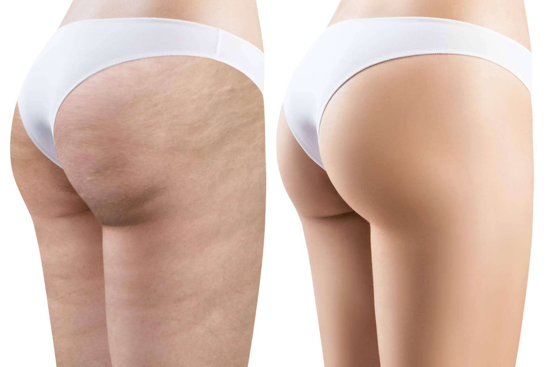 Tratamientos con envolturas de algas reductoras para combatir la celulitis, por Crina Rus Beauty Center