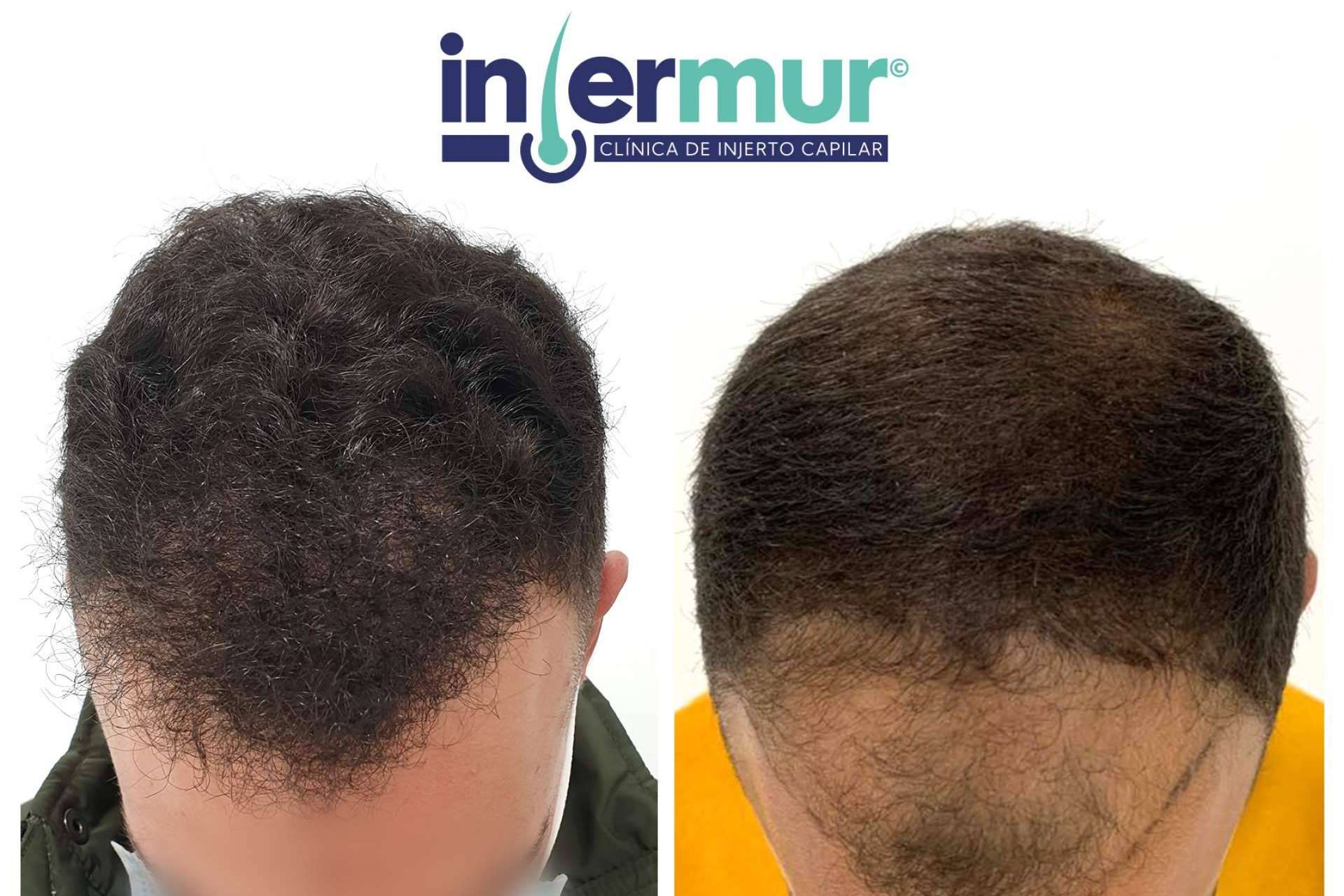 Injermur explica cómo se puede combatir la alopecia androgénica