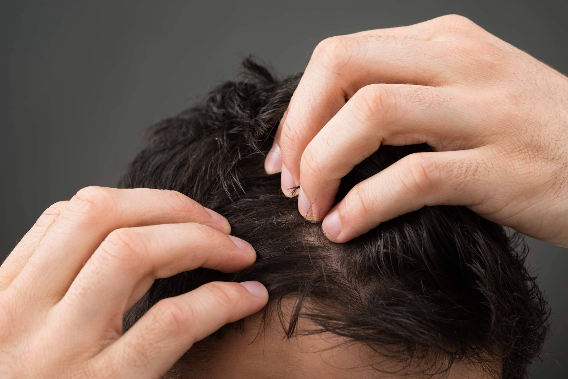 Los distintos tipos de caídas del pelo, por el Laboratorio Géomer