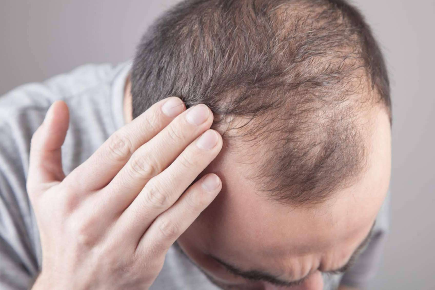 Saw Palmetto ofrece Xpecia Tablet, una alternativa para combatir la alopecia