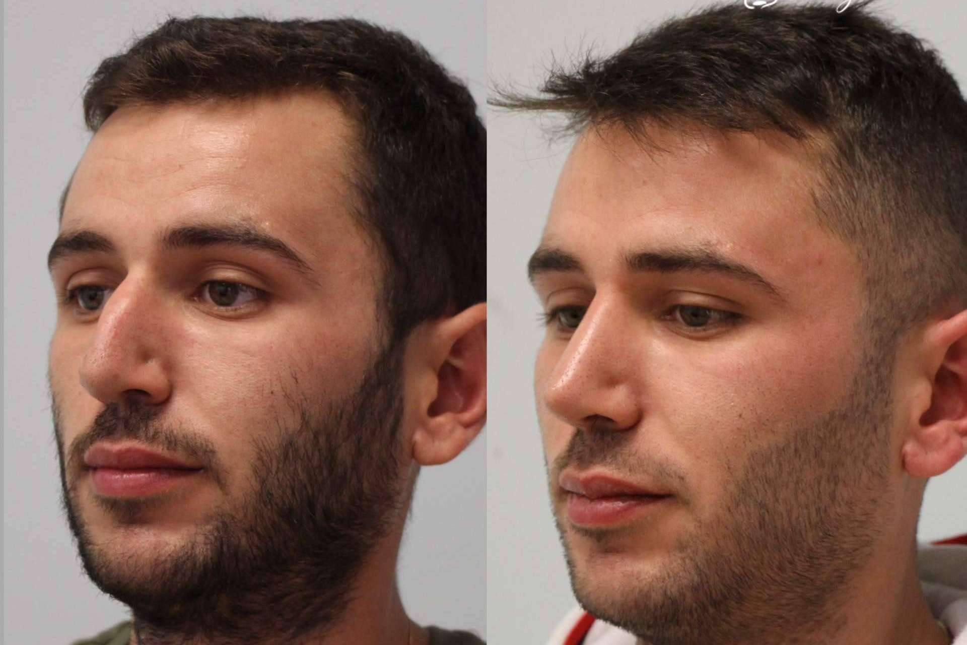 En Valladolid y Santander está disponible el avance médico de la rinoplastia ultrasónica
