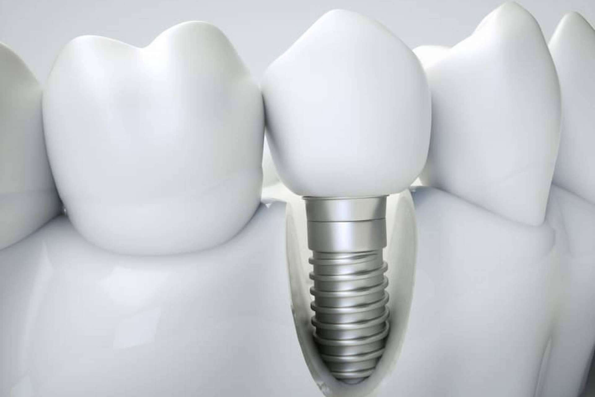 La implantología dental de carga inmediata de Clínica Dental Ahoa