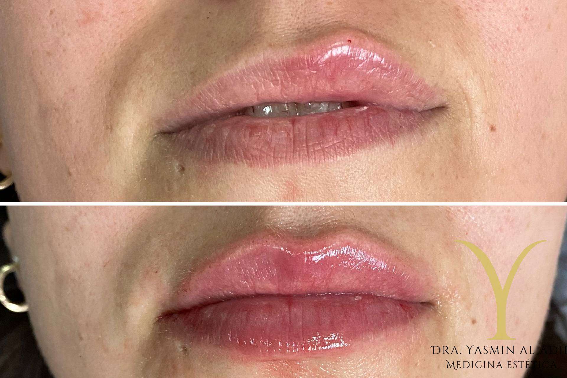 Adiblips, la técnica de la Clínica Yasmin para el aumento de labios con ácido hialurónico