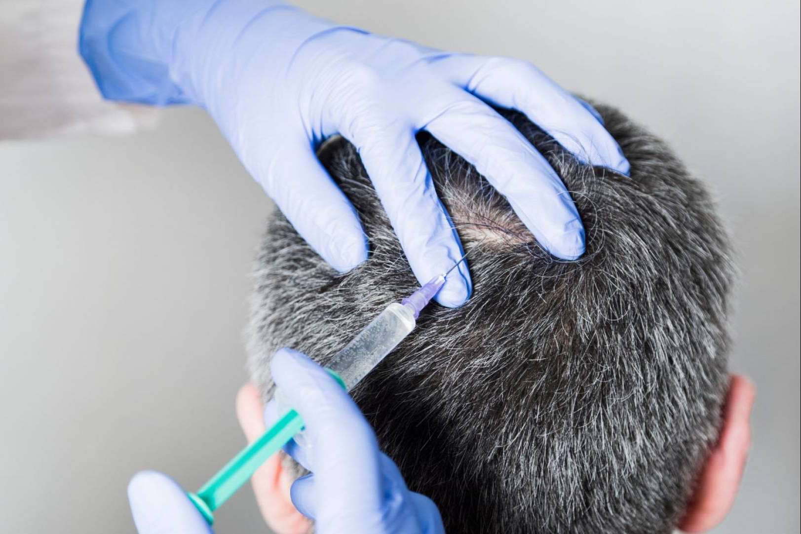Los diferentes tipos de alopecia, por la Clínica Capilar Laura Agrelo