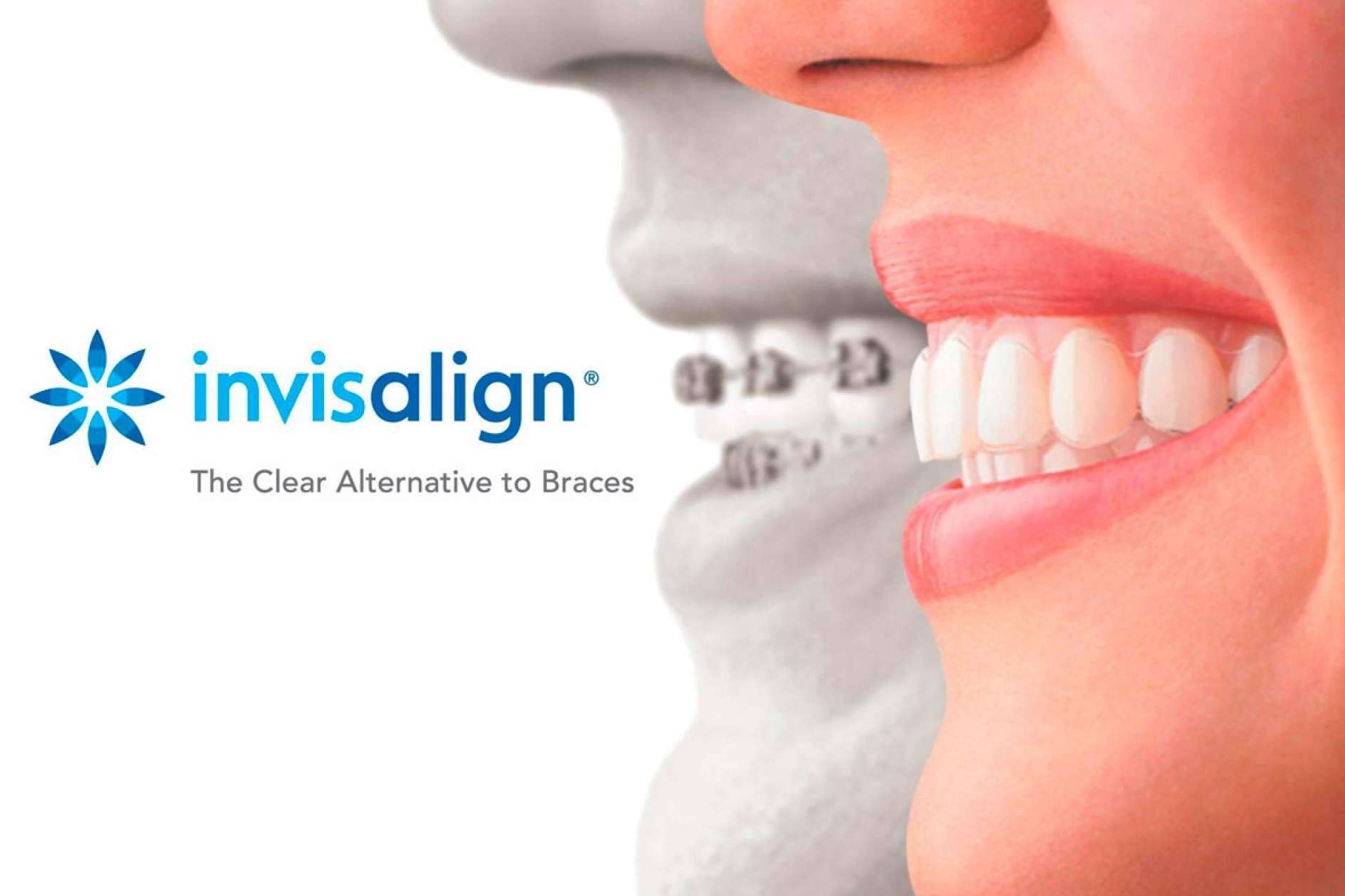 La ortodoncia invisible Invisalign, la alternativa perfecta a los brackets