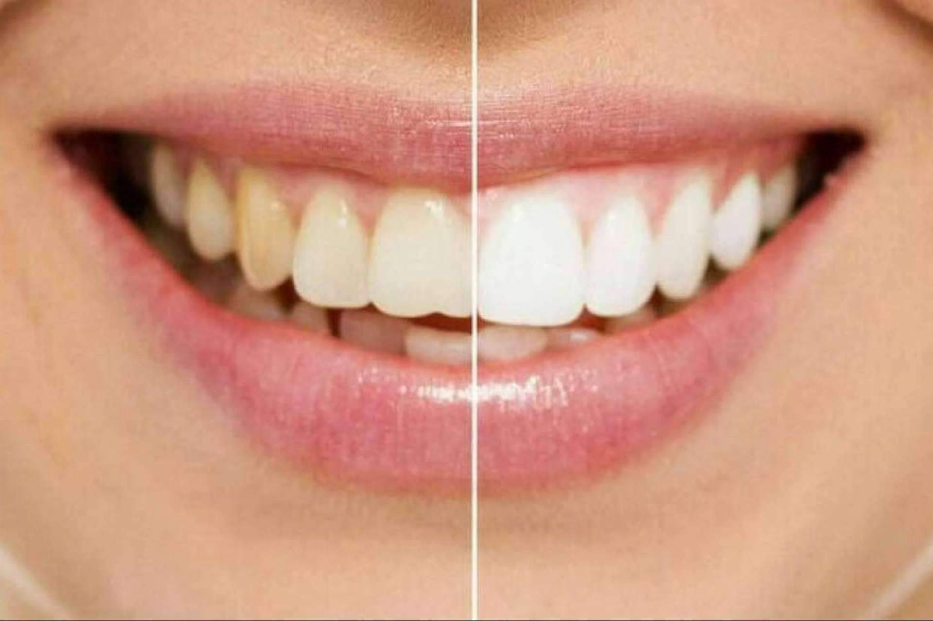 Para conseguir una sonrisa perfecta, ¿Carillas o blanqueamiento?