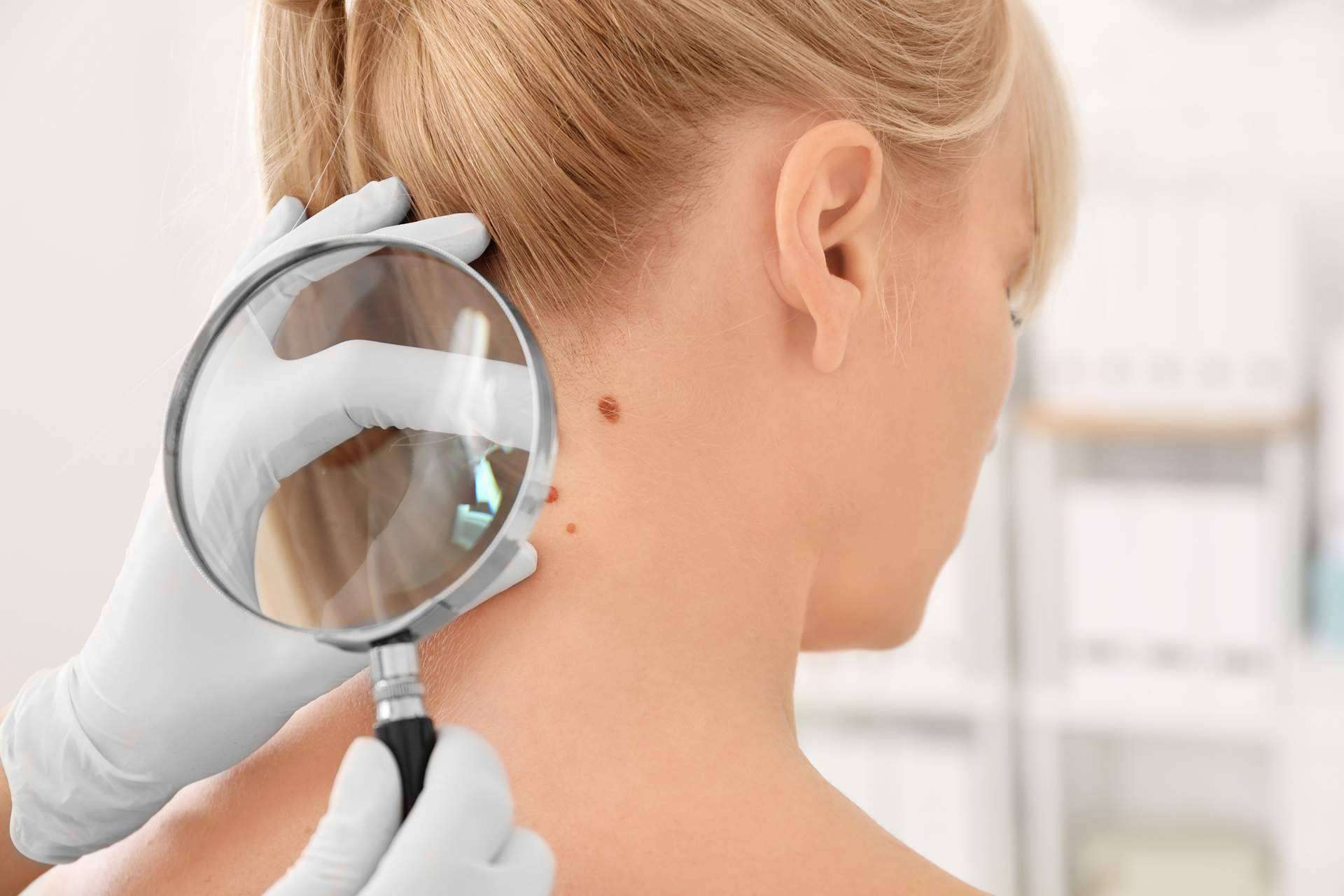 Tecnología de vanguardia para eliminar verrugas y lunares, en el Centro Médico El Pilar