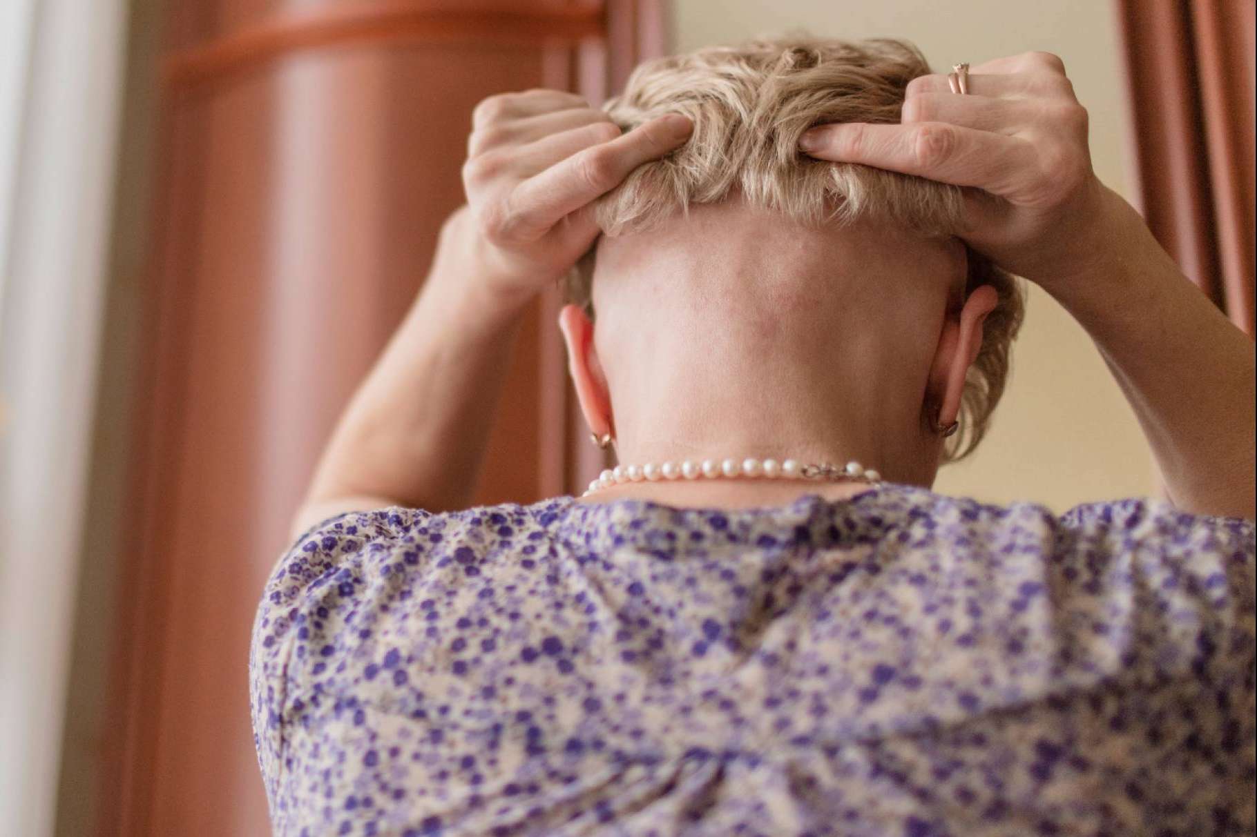 Prótesis capilares, la alternativa a la pérdida de cabello