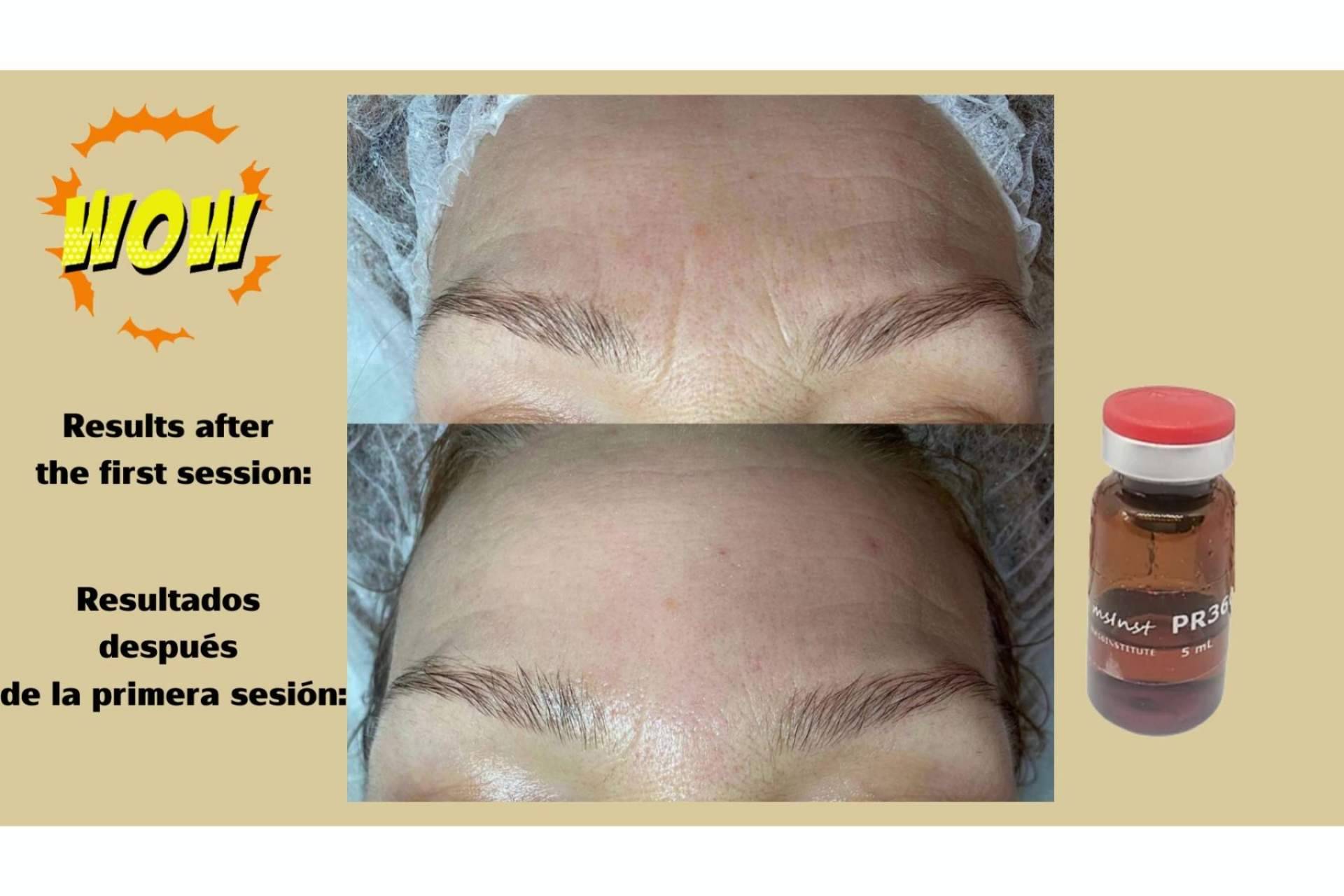 ¿Es recomendable realizarse el peeling químico?