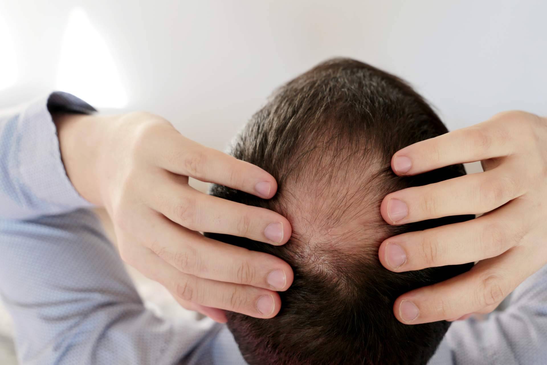El trasplante de pelo en la coronilla se convierte en la solución definitiva para la alopecia en esta zona
