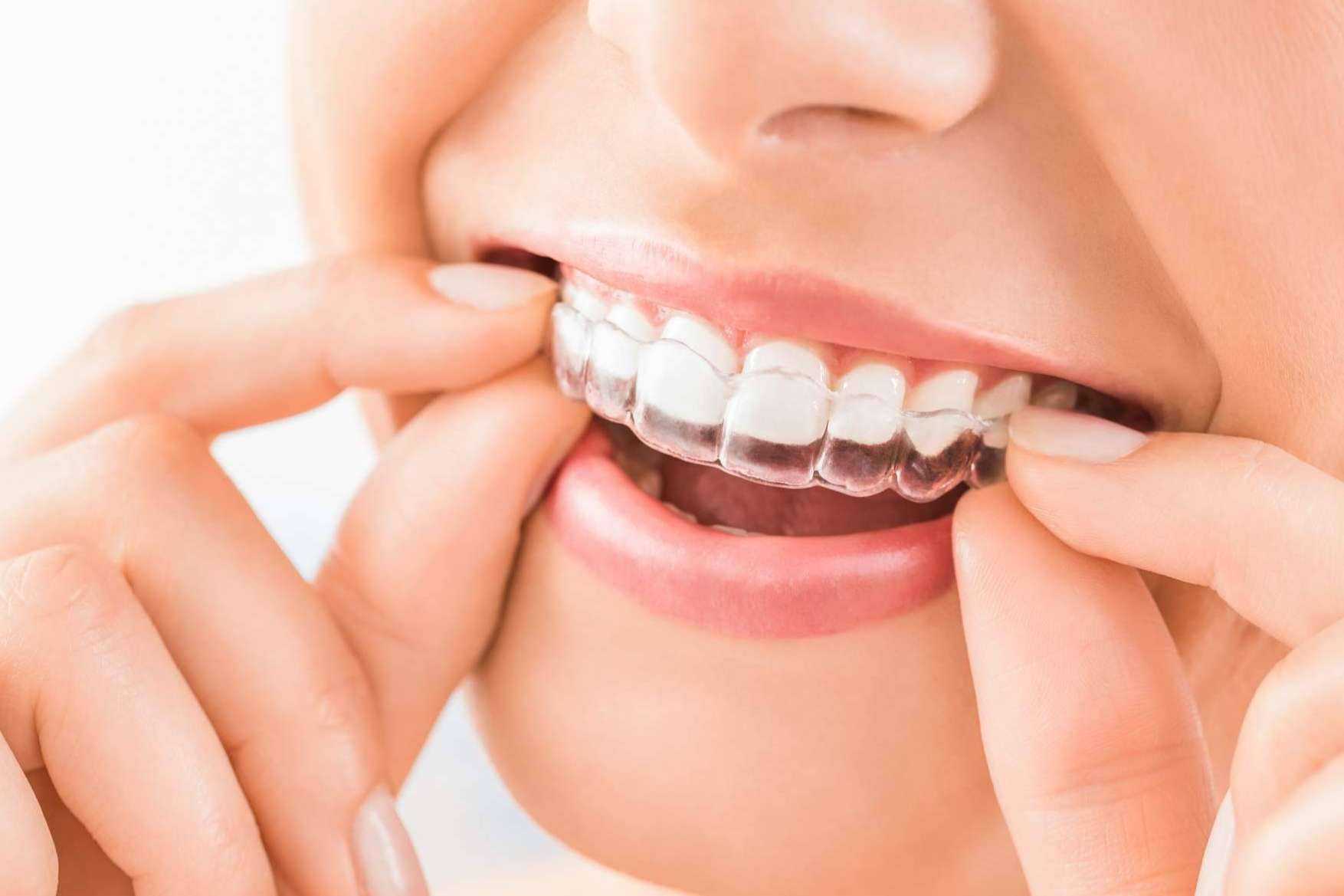 El tratamiento Invisalign permite corregir la sonrisa de forma estética en Sevilla, con Clínicas Dental Bell