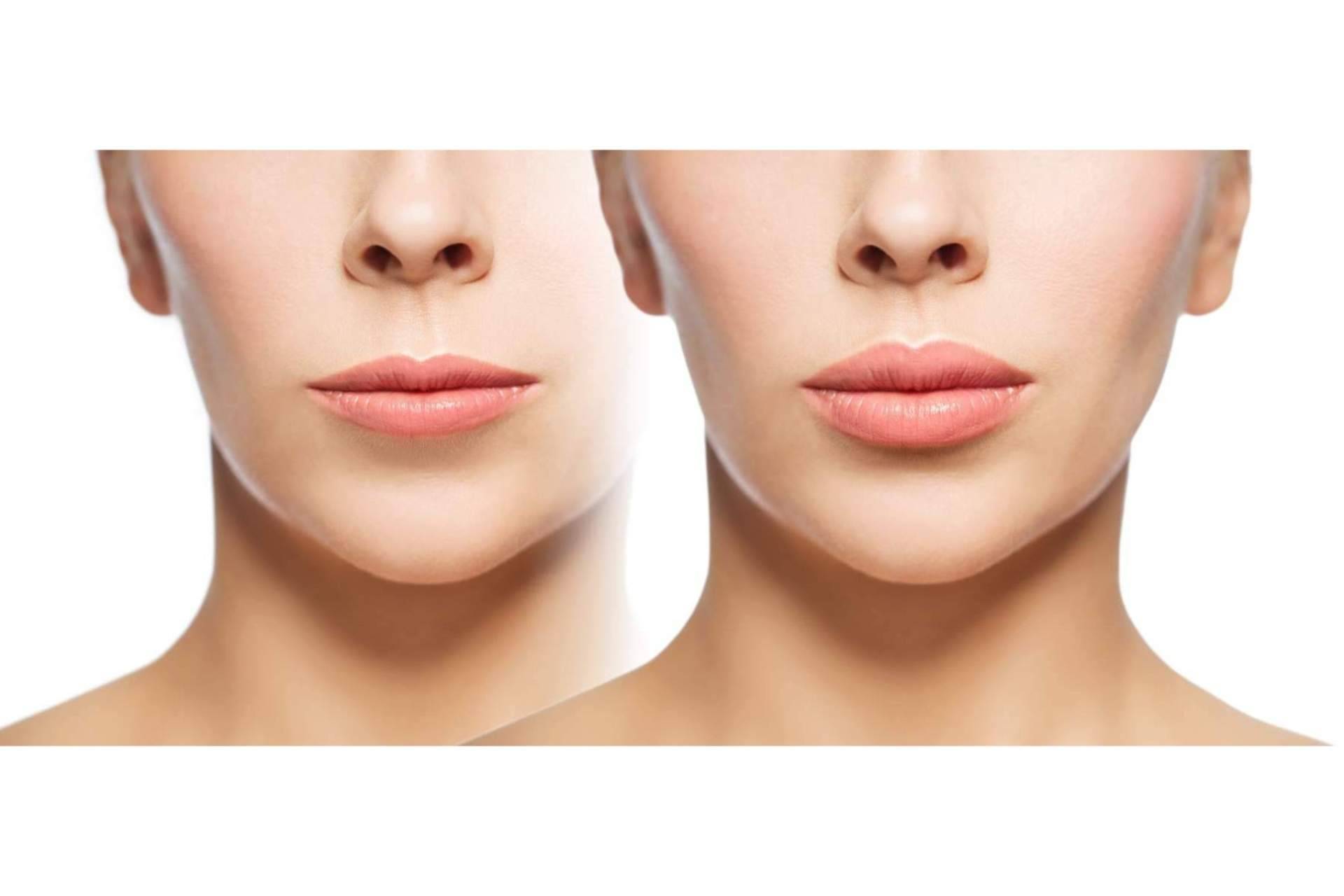 Técnicas de bio-revitalización con mesoHYAC-16 by mesoINSTITUTE