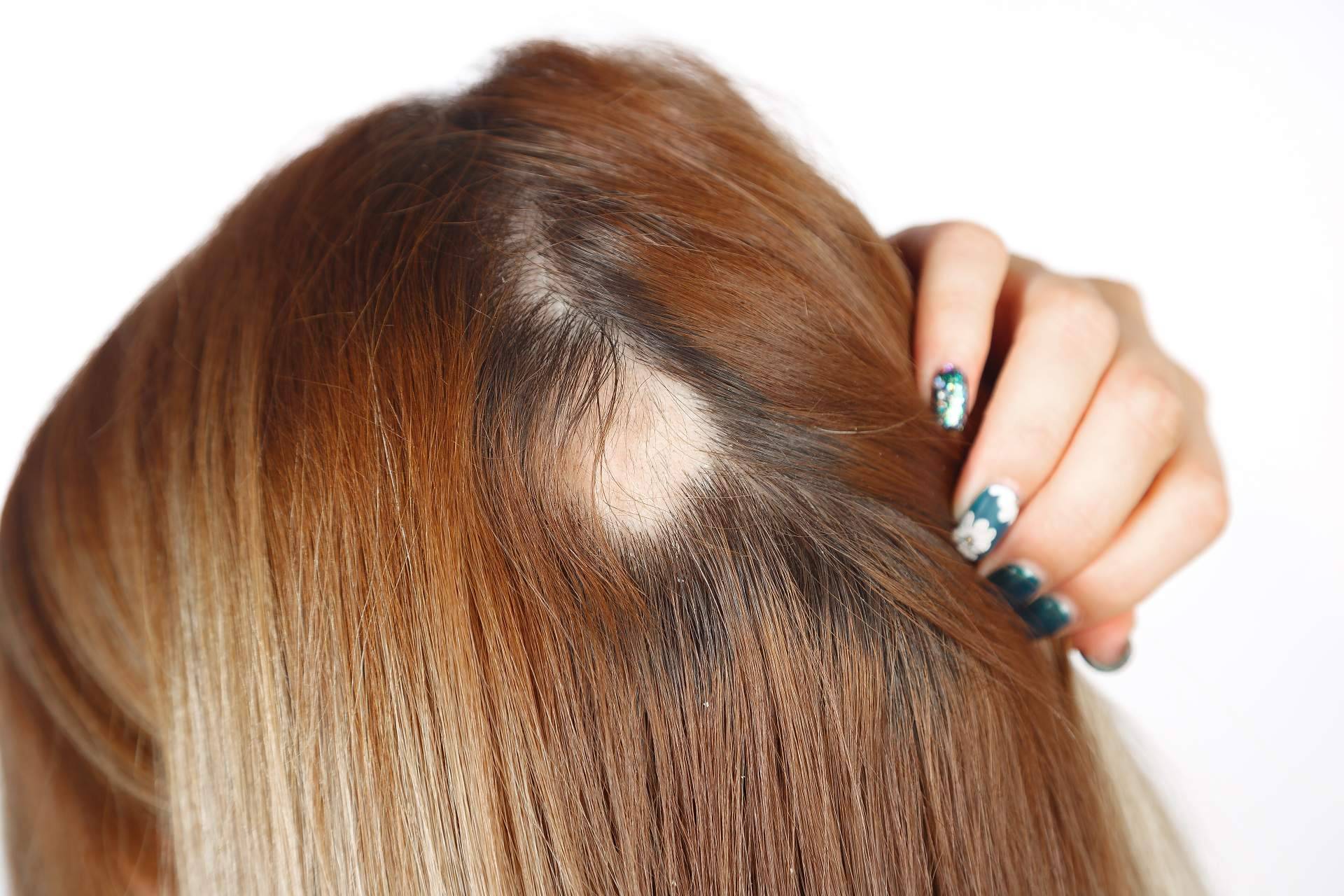 Capilar Innovation Clinic, especialistas en cualquier tipo de alopecia femenina